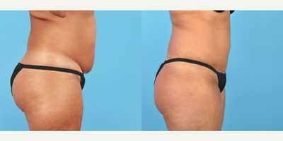 Tummy Tuck before and after photo