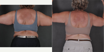 Arm Lift before and after photo