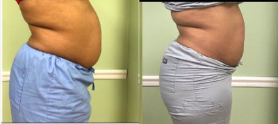 BodyFX before and after photo