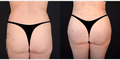Brazilian Butt Lift before and after photo