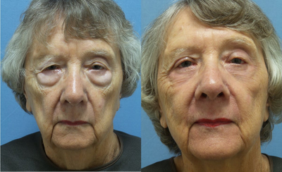 Laser Resurfacing before and after photo
