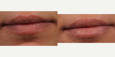 Lip Fillers before and after photo