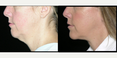 Neck Lift before and after photo