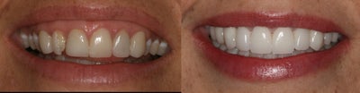 Porcelain Veneers before and after photo