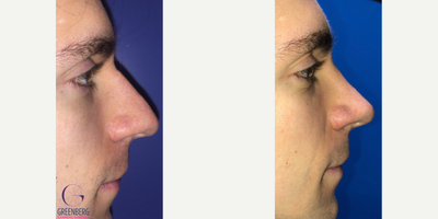 Rhinoplasty before and after photo