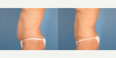 Tummy Tuck before and after photo