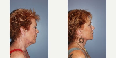 Deep Plane Facelift before and after photo