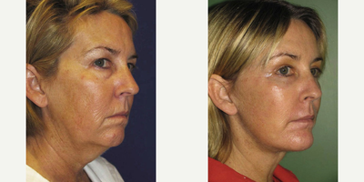 Facelift before and after photo