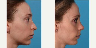 Revision Rhinoplasty before and after photo