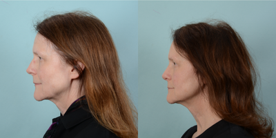 Rhinoplasty before and after photo