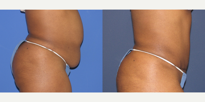 Tummy Tuck before and after photo