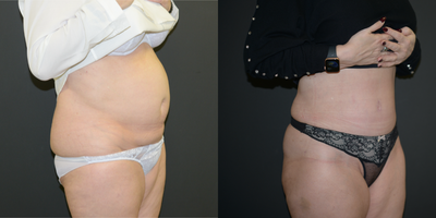 Tummy Tuck before and after photo