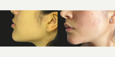 Buccal Fat Removal before and after photo