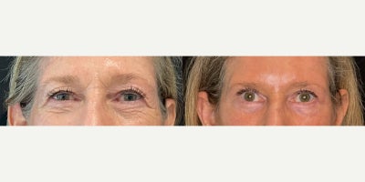 Eyelid Surgery before and after photo