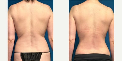 Liposuction before and after photo