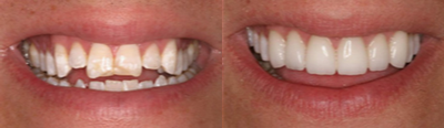 Porcelain Veneers before and after photo
