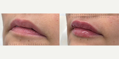 Restylane Kysse before and after photo
