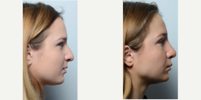 Rhinoplasty before and after photo