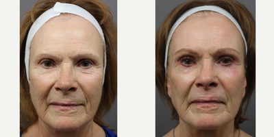 Skin Rejuvenation before and after photo