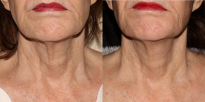 Bellafill before and after photo
