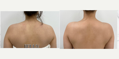 Botox before and after photo