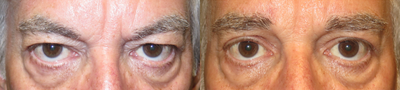 Brow Lift before and after photo