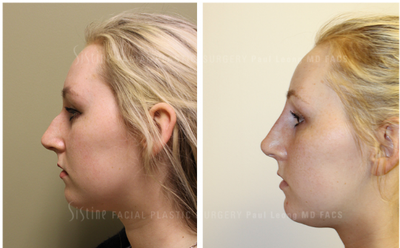 Nonsurgical Nose Job before and after photo