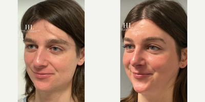 Adam's Apple Reduction before and after photo