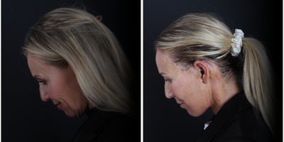 Deep Plane Facelift before and after photo