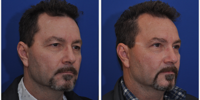 Eyelid Surgery before and after photo