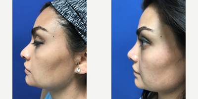 Rhinoplasty before and after photo
