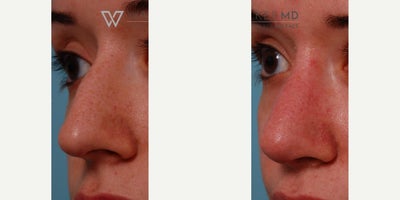 Rhinoplasty before and after photo