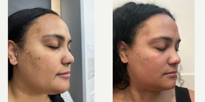 VI Peel before and after photo