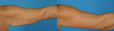 Arm Lift before and after photo