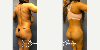 Brazilian Butt Lift before and after photo