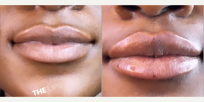 Dermal Fillers before and after photo