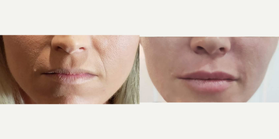 Lip Fillers before and after photo