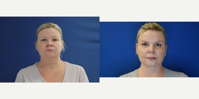 Neck Lift before and after photo
