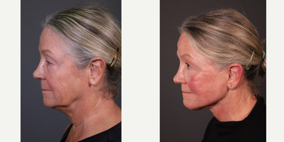 Facelift before and after photo