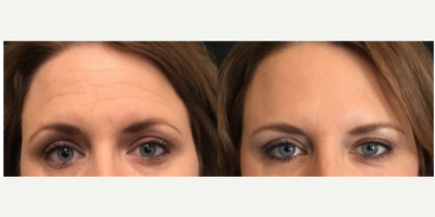Botox before and after photo