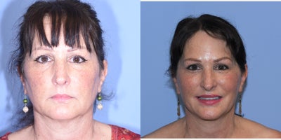 Facelift before and after photo