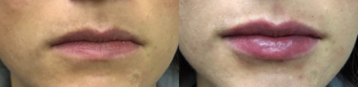 Juvederm before and after photo