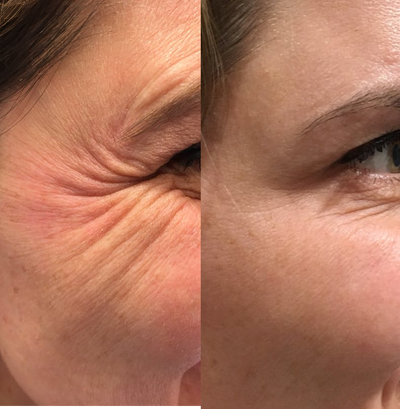Botox before and after photo