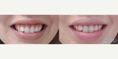 Botox before and after photo