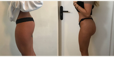 Butt Augmentation before and after photo