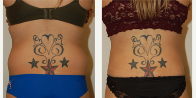 Liposuction before and after photo