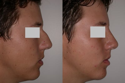 Rhinoplasty before and after photo