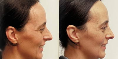 Septoplasty before and after photo