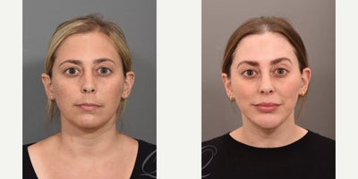 Chin Implant before and after photo