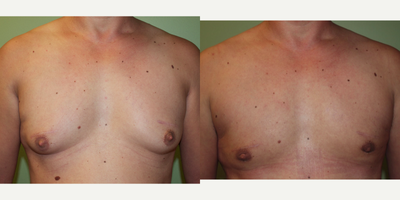 Gynecomastia Surgery before and after photo